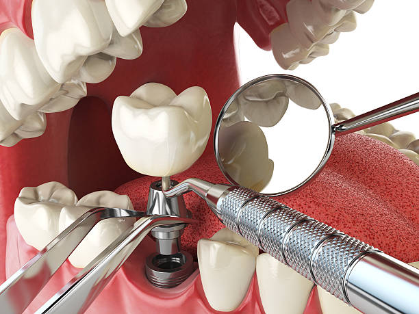 Best Emergency Dental Extractions in South Amherst, OH